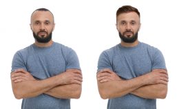 Så fungerar hårtransplantation hos 85 Kliniken